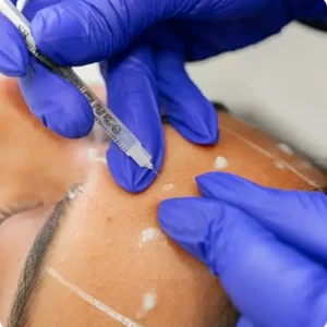 Full face Botox (frente, entrecejo y patas de gallo)